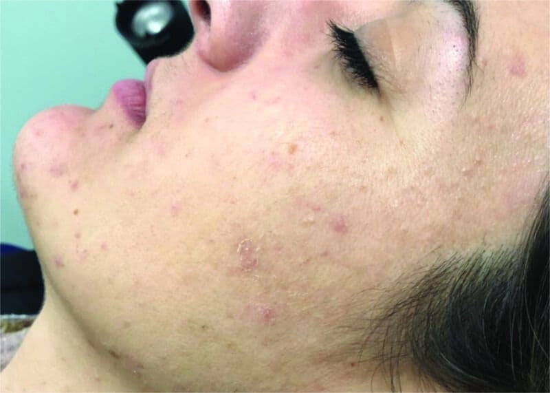 Laser Genesis After 1