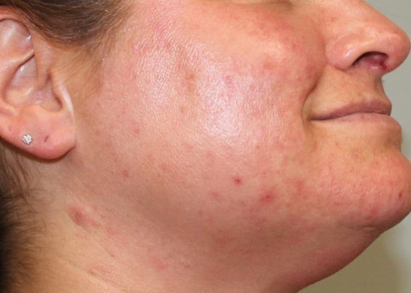 Laser Genesis Before