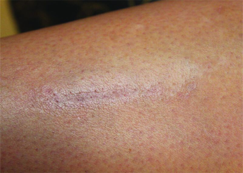 Laser Genesis Scar Treatment After