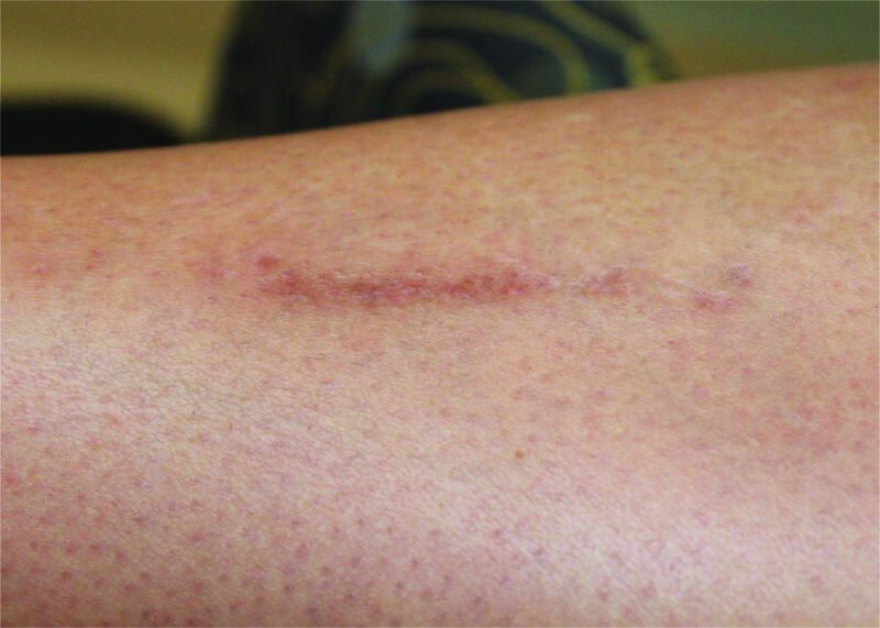 Laser Genesis Scar Treatment Before
