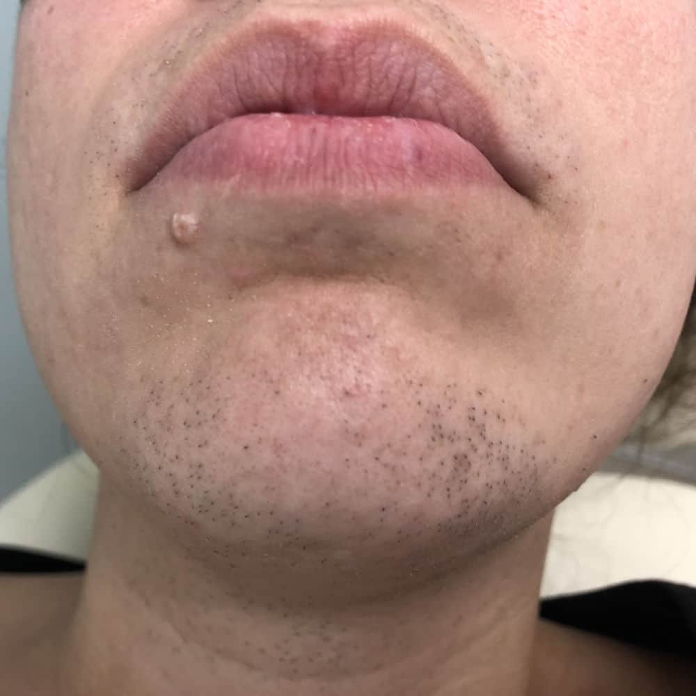 Laser Hair Removal Before