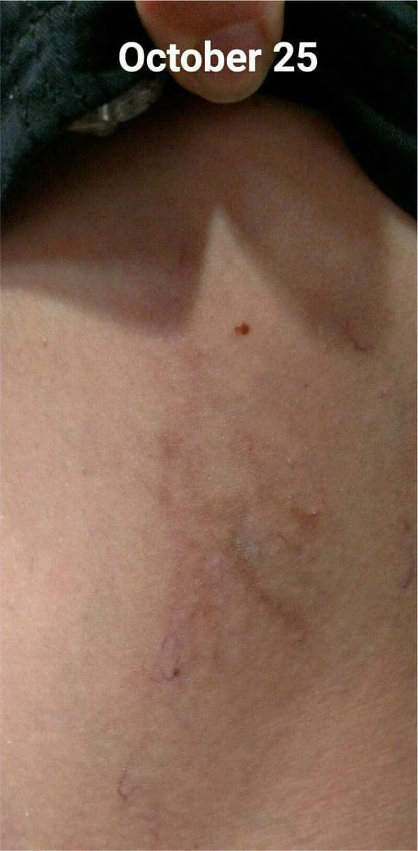 Vascular Laser Treatment After Image