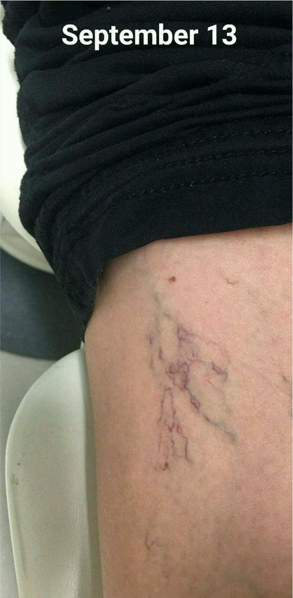 Vascular Laser Treatment Before Image