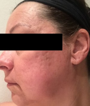 Pearl Fractional Laser