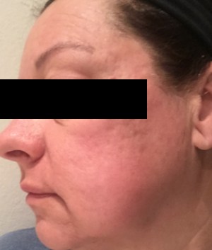 Pearl Fractional Laser